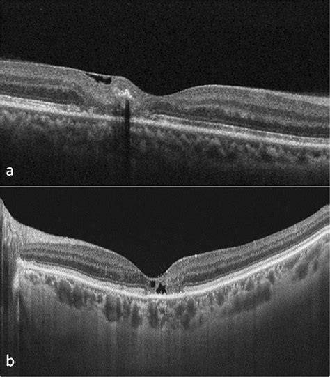 Optical coherence tomography (OCT) features of macular telangiectasia... | Download Scientific ...