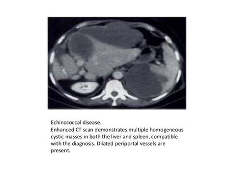 Imaging of spleen ct and mri