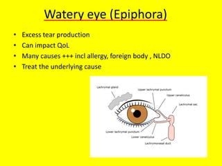 Primary care ophthalmology teaching | PPT