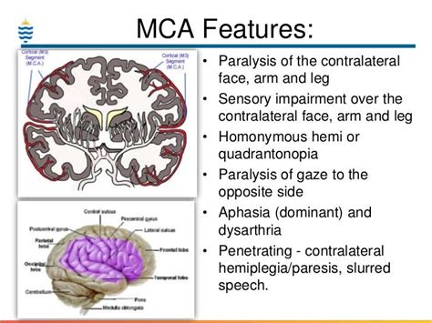 Symptoms And symptoms Of Left Mca Stroke