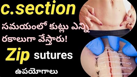 c section stitches types/zip sutures uses/pregnancy care/c section methods - YouTube