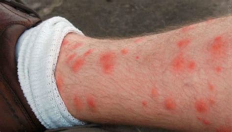 How to get rid of Chiggers and their Bites? - BigBear Pest Control