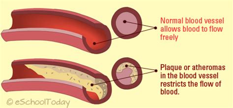 Atherosclerosis Treatment With Homeopathy - Alan Freestone