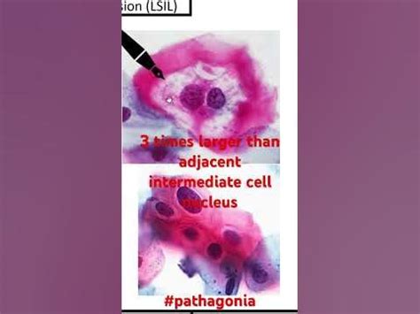 Low grade squamous intraepithelial lesion (LSIL) Pap smear features # ...