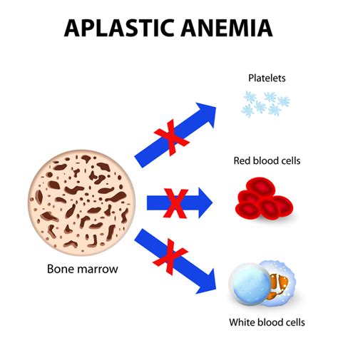 Fanconi anemia: MedlinePlus Genetics