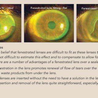 (PDF) A Guide to Scleral Lens Fitting