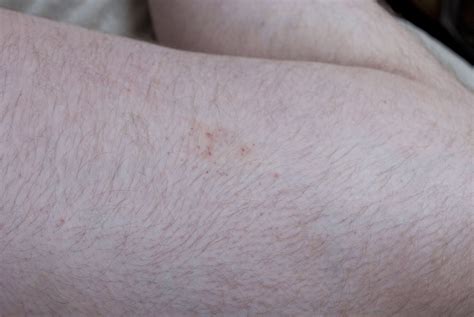 Bestand:Bedbug bites on human thight 1.jpg - Wikipedia