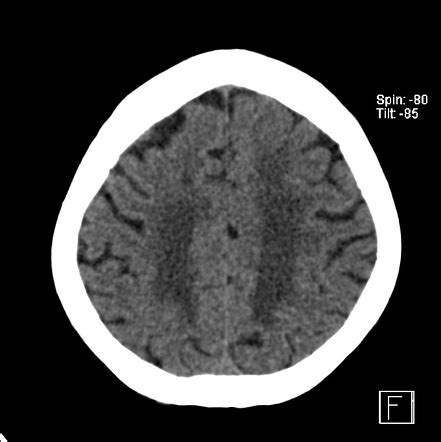 mesa recuperación Sucio tac isquemia cerebral Tiempo de día Tormento ...