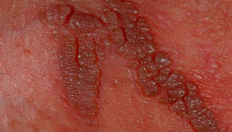 Genital warts - Summerlin Dermatolo­gy