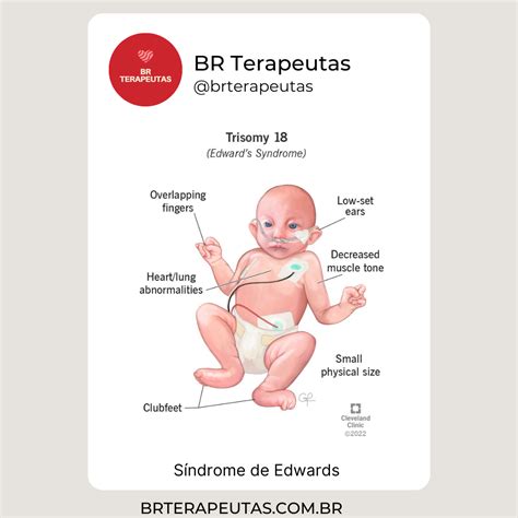 O que é a Síndrome de Edwards (Trissomia 18) - BR Terapeutas