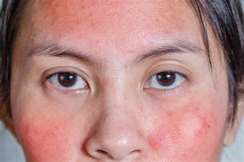 Facial Rash: Causes and Tips