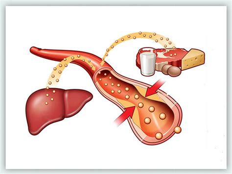 Hyperlipidemia Or High Cholesterol: Causes, Diagnosis And Treatment ...