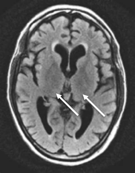 Cureus | Alcohol Induced Wernicke Encephalopathy with Atypical MRI Findings