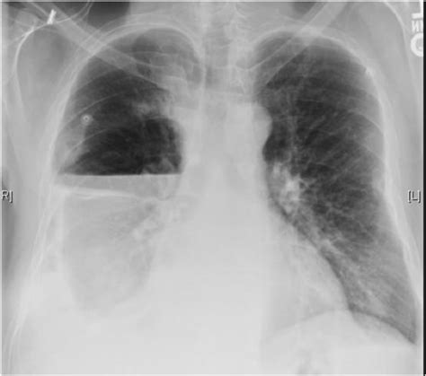 Pneumothorax Ex-vacuo or “trapped lung” in the setting of hepatic ...