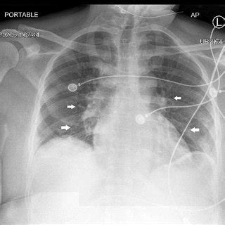 Chest x-ray showing patchy bilateral infiltrates (arrows) | Download Scientific Diagram