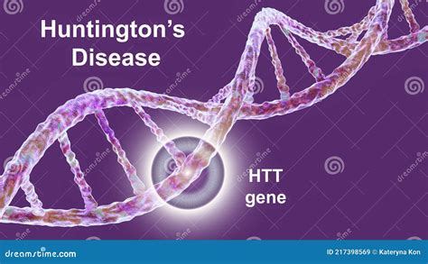 Huntington S Disease, a Neurodegenerative Disease Due To Mutation in ...