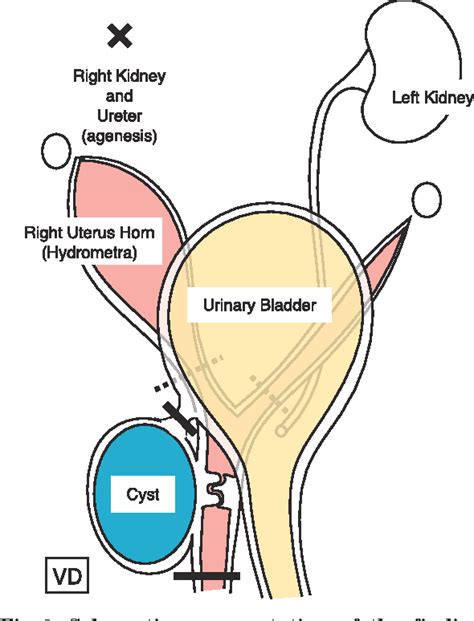 Gartner Duct Cyst Anatomy