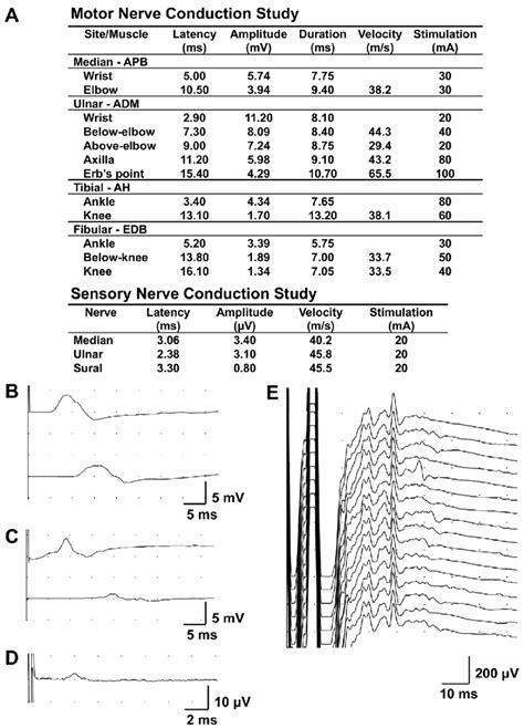 Figure1.Nerve conduction study findings. A: Nerve conduction studies... | Download Scientific ...