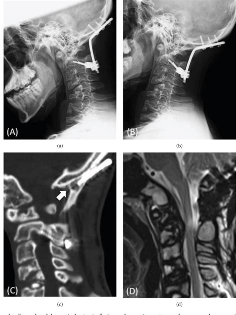 Figure 3 from Successful Treatment of Atlantoaxial Subluxation in an Adolescent Patient with ...