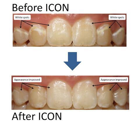 ICON White Spot and Discolored Tooth Treatment | Preventative Dentistry ...