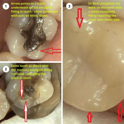 Mercury amalgam fillings and the cracked tooth connection | Dental Pod ...