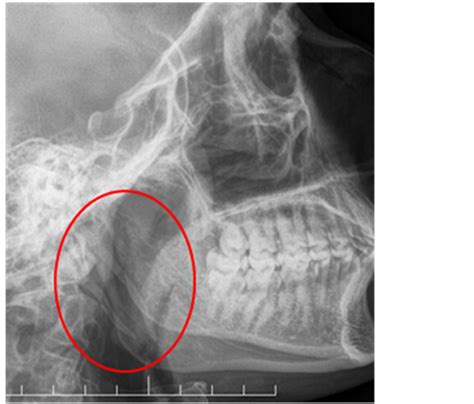 Styloid Process Of Temporal Bone Xray