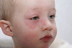 What is Allergic Shiners Dr.Quotane