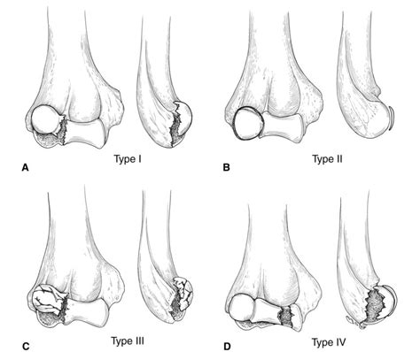 Evaluation and Management of Fractures of the Capitellum - Cancer Therapy Advisor