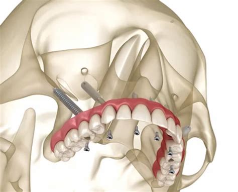 Zygomatic Implant Vs. Bone Graft - OC Dental Center