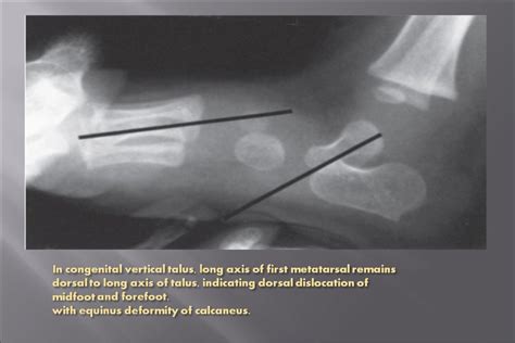 Pes Planus by Dr. Mohammad Azhar ud din Darokhan