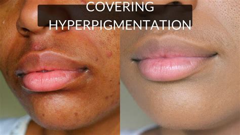 Get Rid of Hyperpigmentation & Dark Circles Around Mouth! - YouTube