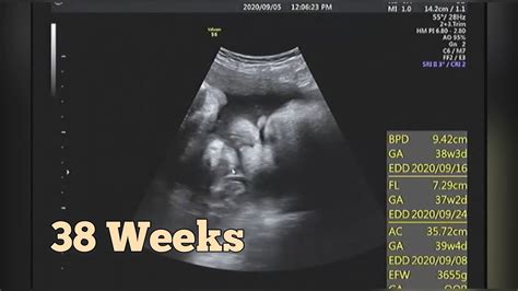 39 Weeks Pregnant Ultrasound