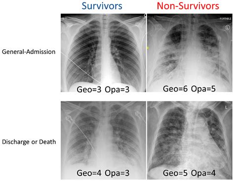 Lung Cancer Vs Pneumonia Xray