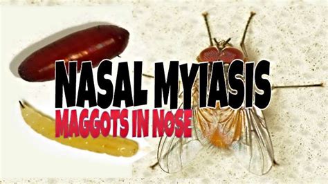 MBBS DOCTORS: Nasal Myiasis: Maggots in Nose