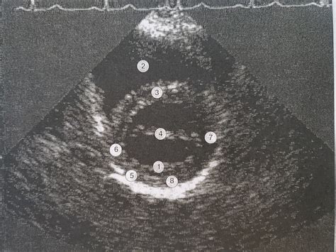 Parasternal short axis view mitral valve level Diagram | Quizlet