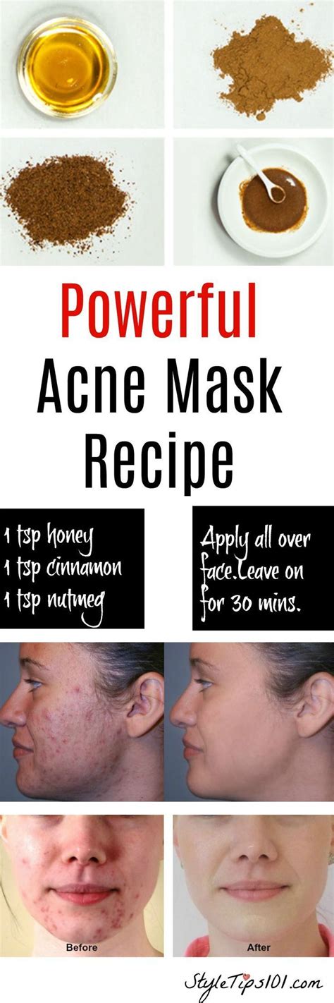 How Facial Masks Can Help Your Skin | Natural acne mask, Home remedies ...