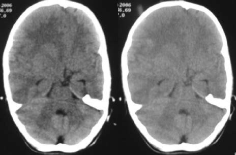 CT scan showing asymmetry of anterior cranial fossa and thinning of ...