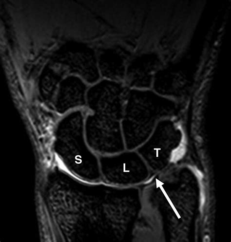 Imaging Key Wrist Ligaments: What the Surgeon Needs the Radiologist to Know | AJR