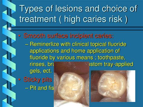 Karies Causes Symptoms Treatment Karies