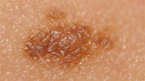 Skin Cancer & Moles | Skin Cancer - YouTube