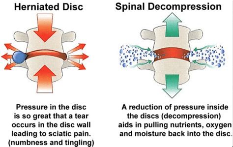 5 Ways Spinal Decompression Can Help After an Accident: Watson ...