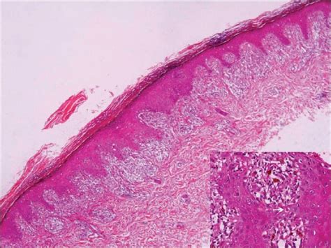 Lichenoid tissue reaction/interface dermatitis: Recognition, classification, etiology, and ...