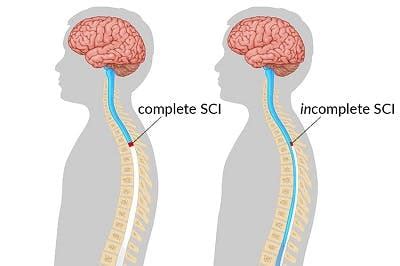 Quadriplegia & Tetraplegia: Paralysis of All 4 Limbs | Flint Rehab