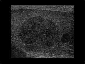 Urinary Tract and male reproductive system | 2.3 Scrotum : Case 2.3.8 ...