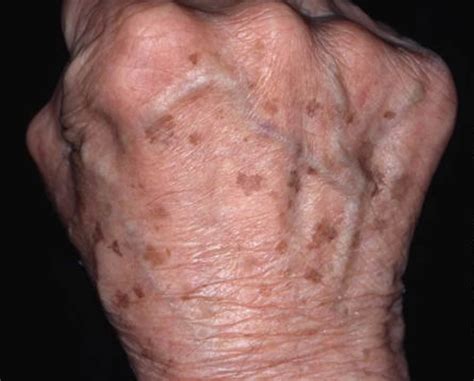 Age Spots - Causes, How To Get Rid, Cream & Treatment