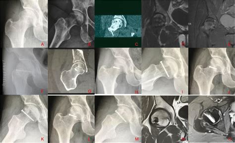 A 32-year-old man with osteonecrosis of the femoral head was treated... | Download Scientific ...