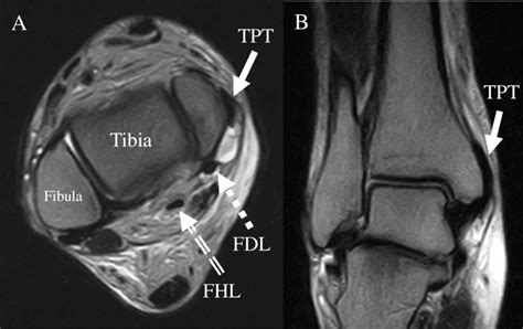 Posterior Tibial Tendon Mri