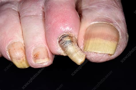 Fungal infection of the toenails - Stock Image - C038/1556 - Science Photo Library