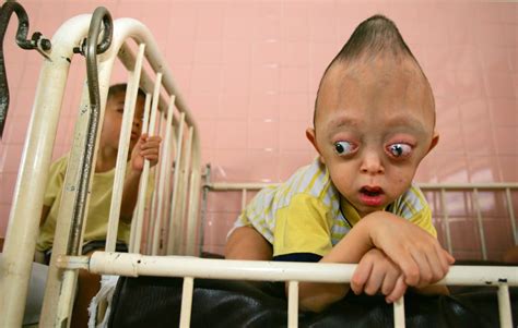 This is a child in Vietnam born with a birth defect due to his parent's ...