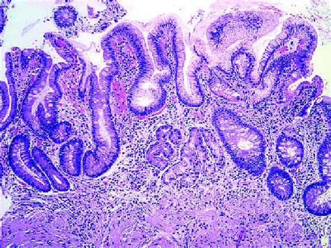 Histologic appearance of autoimmune atrophic gastritis. Autoimmune ...